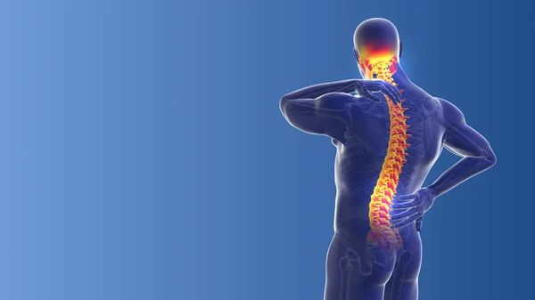 Medizinisches Konzept Der Nacken Und Rückenschmerzen — Stockfoto