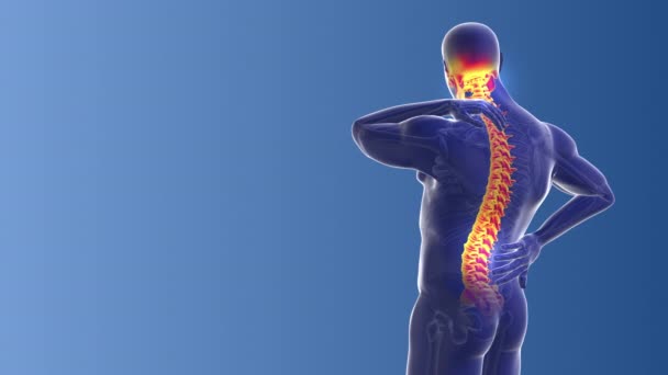 Medizinisches Konzept Der Nacken Und Rückenschmerzen — Stockvideo