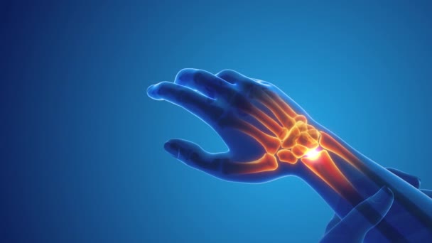 手首関節の痛み — ストック動画
