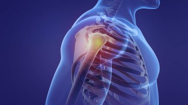 Acılı bir omuz animasyonu