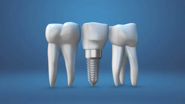Animação Dos Implantes Dentários — Fotografia de Stock