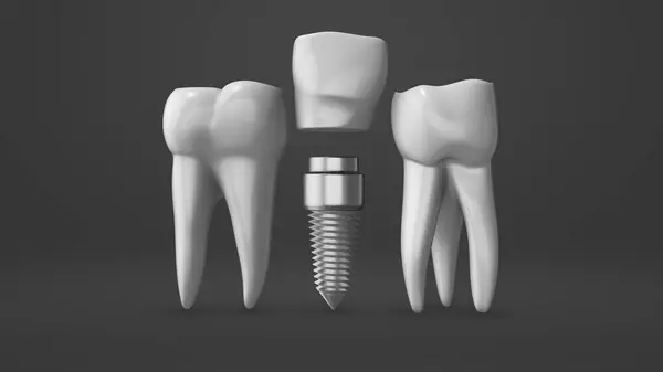 Proces Montażu Implantu Zęba Korony — Zdjęcie stockowe