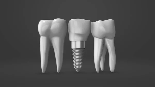 Processo Instalação Implante Dentário Coroa — Fotografia de Stock