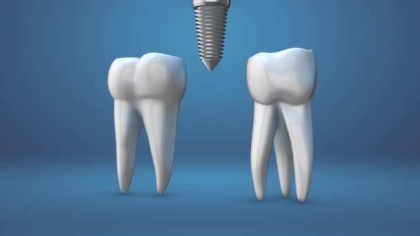 Diş Implantlarının Animasyonu — Stok video
