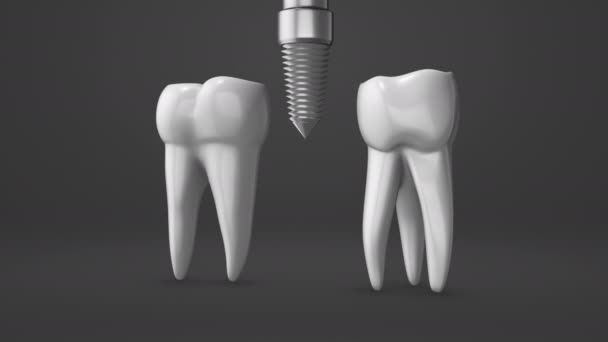 Processo Instalação Implante Dentário Coroa — Vídeo de Stock