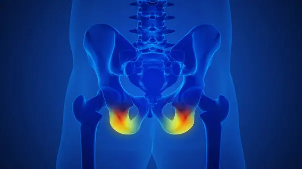 Human Skeleton Painful Hip Joint Pain — Stock Photo, Image