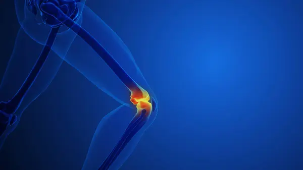 Mavi arka planlı Diz Eklem Ağrısı