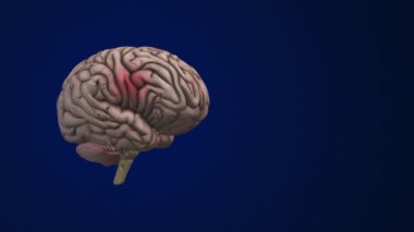 Brain bleed or an intracranial Hemorrhage