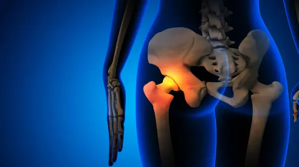 Kemik iltihabı ve eklem ağrısı olan iskelet.