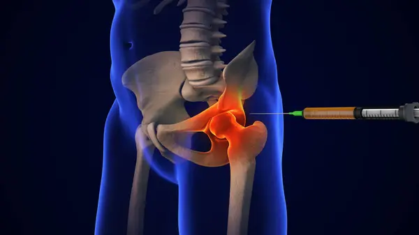 stock image Anatomy Human Hip Joint Treatment