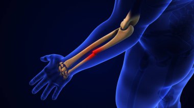 Kırık Ulna Kemik Tıbbi Konsepti