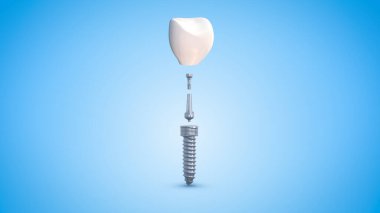 Diş implantını kapat.