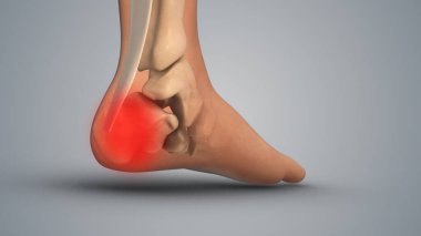 Topukta acı veren bir iltihap.