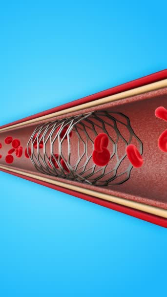 Клетки крови, протекающие через стентированный сосуд