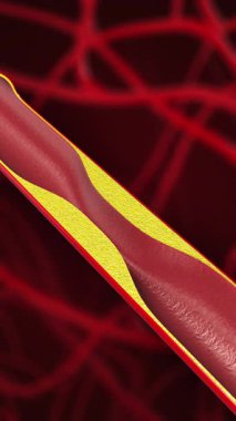 Vasküler Stent yerleştirme ile Dolaşım Desteği