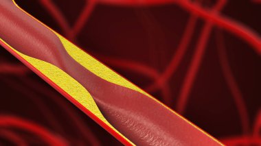 Kolesterolle kan damarı tıkanmış.