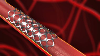Kalp için anjiyoplasti ve stent yerleştirme