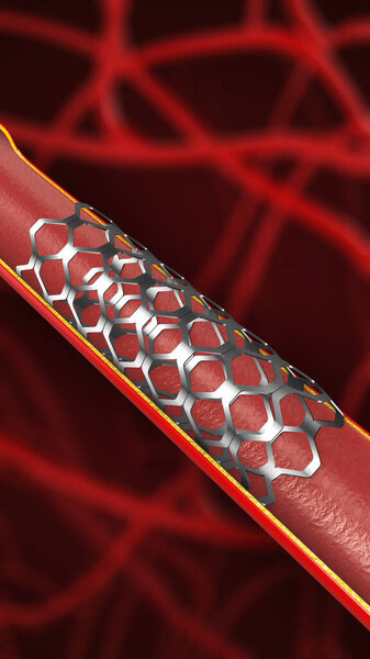 Angioplasty and Stent Placement for the Heart