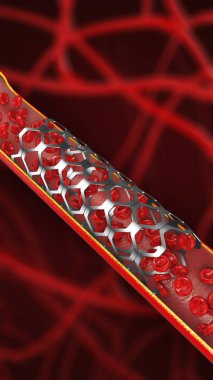 Tıkanmış Arter ve Kan Akımı Dolaşımı