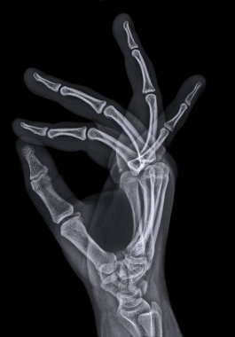 X ray or radiograph of hand seen from sideways and spreading the fingers