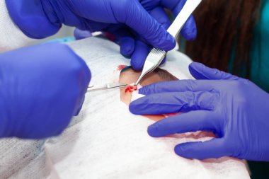 Deri lezyonu çıkarma prosedürü. Dermatolog, genç bir erkek hastanın yüzünde iyi huylu deri lezyonunun alınmasını gerçekleştiriyor..