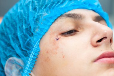 Dermatolog muayenehanesinde iyi huylu deri lezyonu alındıktan sonra genç bir erkek hastanın yüzünü kapatın..