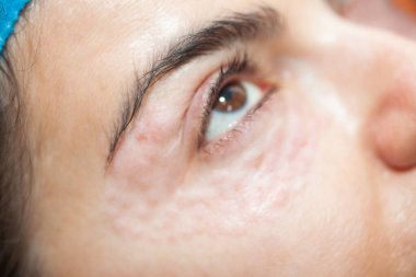 Dermatolog muayenehanesinde göz kapaklarında mesoterapi uygulanan kadın hasta..