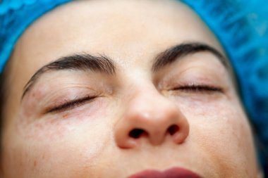 Dermatolog muayenehanesinde göz kapaklarında mesoterapi uygulanan kadın hasta..