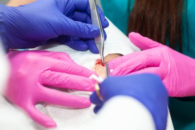 Küçük bir ameliyat sırasında hastaya dikiş atan bir doktor. Dermatolog, genç bir erkek hastanın yüzünde iyi huylu deri lezyonunun alınmasını gerçekleştiriyor..