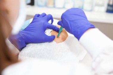 Dermatolog, yaşlı bir hastanın yüzünde deri biyopsisi yapıyor. Deri lezyonu çıkarma prosedürü. Biyopsi yumruğu.