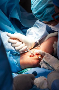 Bir grup cerrah dirsek ameliyatı yaparken hastanın kolunu kapat. Kadın bir doktor ameliyat yapıyor. Ameliyat ve sigorta konsepti