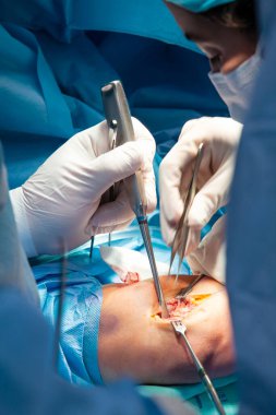 Dirsek ameliyatı yapan bir grup cerrahın ellerini kapatıyoruz. Kadın bir doktor ameliyat yapıyor. Ameliyat ve sigorta konsepti.