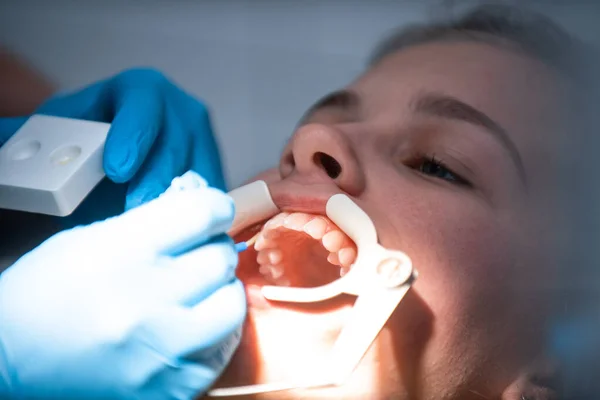 stock image Dentist appointment at a dental clinic, placing braces locks on the teeth and pulling the archwire to fix it. 