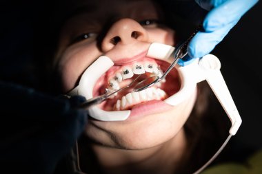 Close up of girl with brackets receiving dental braces treatment in clinic. 