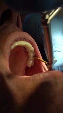 İmplant işlemi sırasında diş implantı içine diş implantı yerleştirmek için tork anahtarı kullanan bir dişçinin videosunu kapat.. 