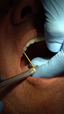 İmplant işlemi sırasında diş implantı içine diş implantı yerleştirmek için tork anahtarı kullanan bir dişçinin videosunu kapat.. 