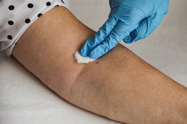 Hastaların B.2.86 virüsüne karşı aşılanmasından hemen sonra, tek kullanımlık mavi eldiven giyen bir doktor kan akışını durdurmak için tıbbi pamuk kullanıyor. Yüksek kalite fotoğraf