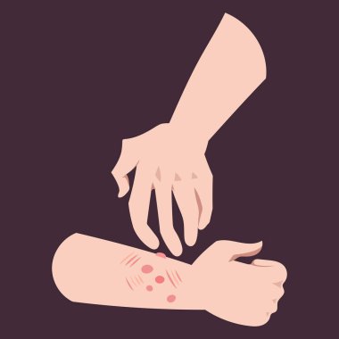 İnsan kolu böcek ısırıkları yüzünden kaşınıyor. Kolunda kurdeşen ya da şişlik var. Kare koyu arkaplanda izole edilmiş basit düz renkli çizimler.