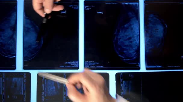 Lékaři Při Pohledu Mamografii Rentgeny Close — Stock video