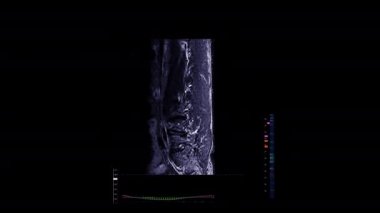 MRI Lumbar Back Bones Data ScreenA computer screen with a futuristic diagnosis of the backbone's lumbar skeletal area.