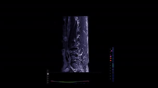 Mri Lumbar Back Bones Data Screena Computer Screen Futuristic Diagnosis — Video