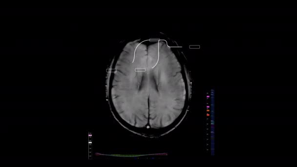 Brain Mri Scans Diagnostic Tech Data Screencomputer Screen Brain Mri — Stockvideo