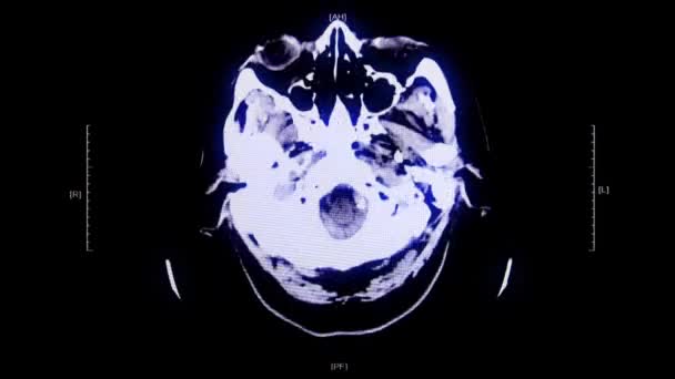 Stock Motion Graphics Pack Features Medical Brain Cat Scans Cranial — Stockvideo