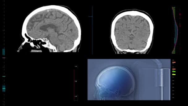 Ensemble Scanners Cérébraux Irm Haute Technologie Avec Différents Angles Données — Video