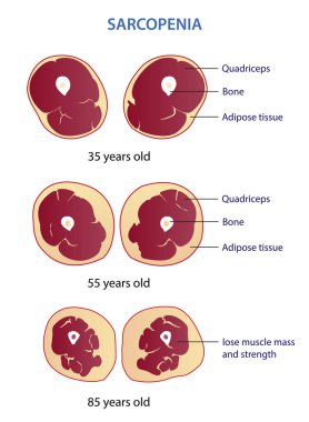 Infographic of sarcopenia vector illustration isolated on white background. Cross section of losing muscle mass and strength in different age. Anatomy and health care concept illustration. clipart
