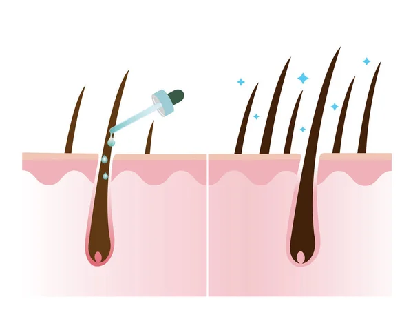 Hair Density Treatment Vector Isolated White Background Increase Hair Density — Stok Vektör
