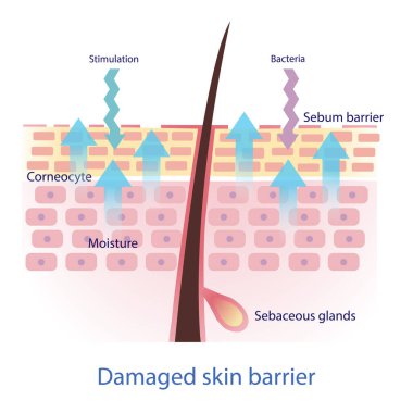 Damaged skin barrier vector. The sebum barrier decreased, tight arrangement between the skin cells is lost. This allows external irritants to get in skin a lot easier and lead to more water leaving skin. Skin care and beauty concept illustration.
