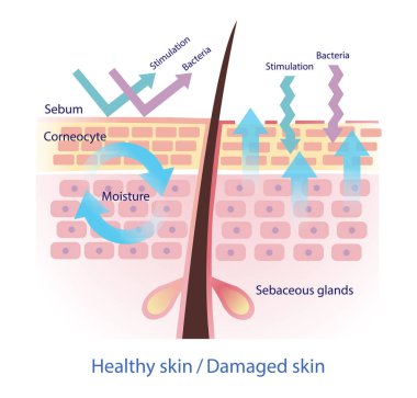 Comparison of healthy and damaged skin barrier vector on white background. The healthy sebum barrier protect skin from stimulation and bacteria. When sebum decreased, this lead to more water leaving skin. Skin care and beauty concept illustration. clipart