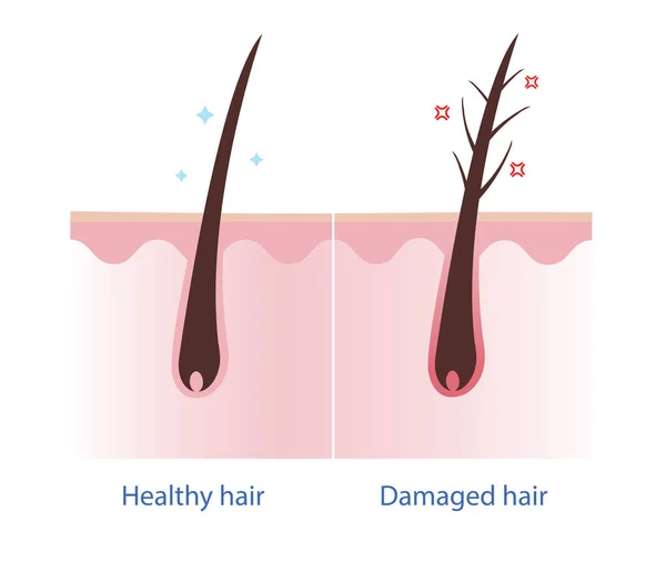Υγιή Μαλλιά Και Κατεστραμμένα Μαλλιά Διάνυσμα Στρώμα Τριχωτού Της Κεφαλής — Διανυσματικό Αρχείο