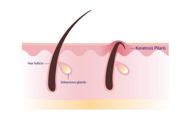 Keratosis Pilaris. Chicken skin vector on white background. Hair has grown back into the skin surface illustration. Atopic Dermatitis Infographic.